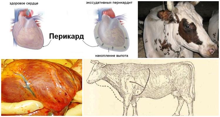 травматический перикардит