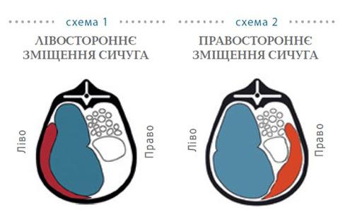 смещение сычуга у коров